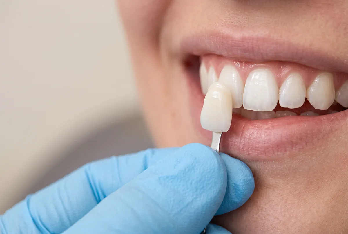 Clareamento dentário